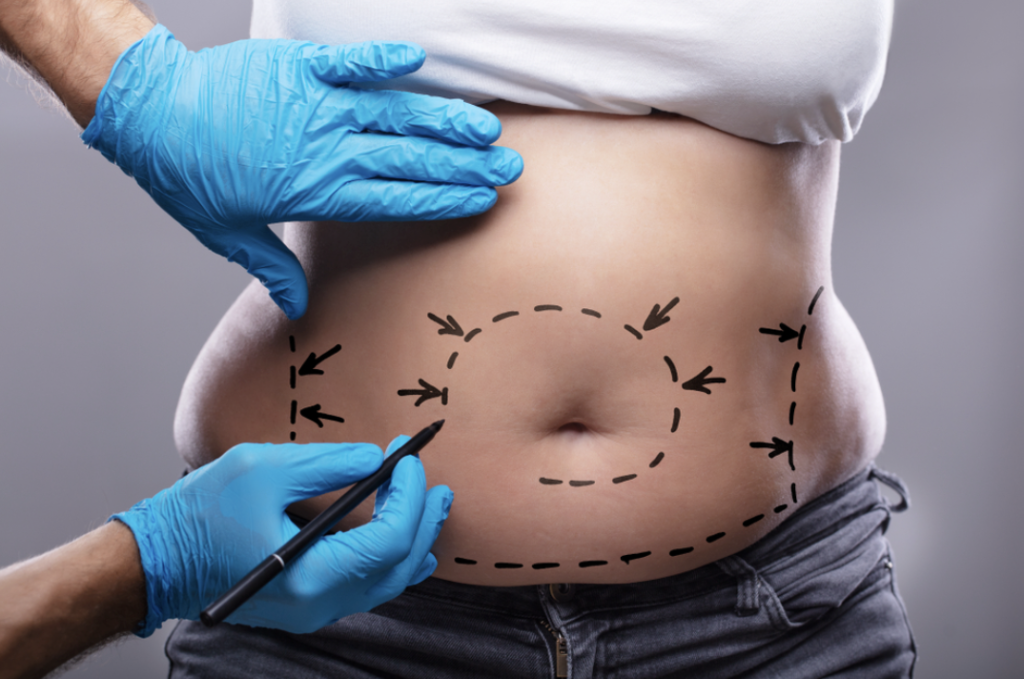 Abdominoplastia după sarcină
