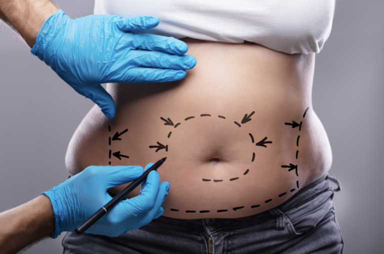 Abdominoplastia după sarcină